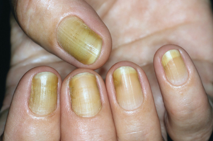 yellow nail syndrom